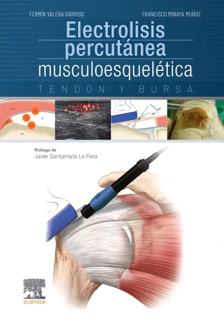 Electrolisis Percutánea Musculoesquelética. Tendón y Bursa
